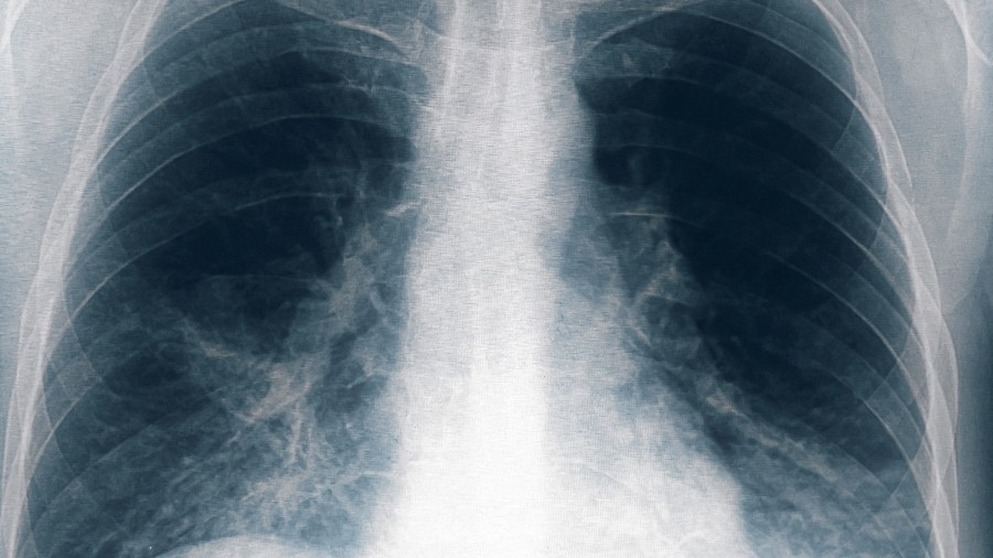 Ocho nuevos casos de neumonía bilateral por Legionella en Tucumán | Actualidad
