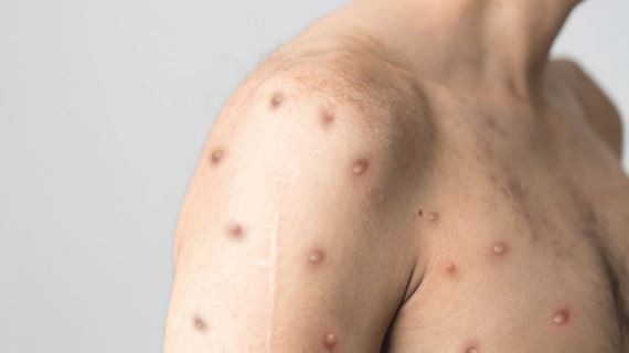 Inician en EEUU ensayos clínicos de una vacuna contra la viruela del mono | Internacionales