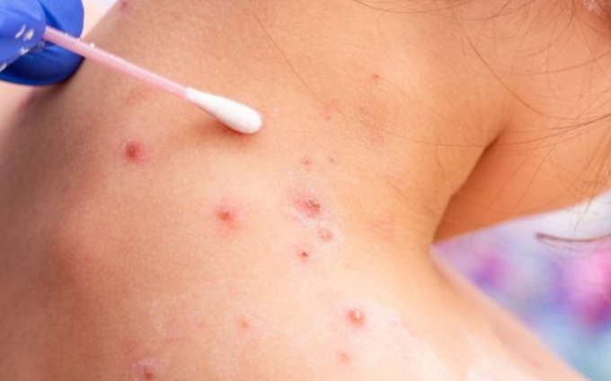 Viruela del mono: confirman un total de 396 casos en la Argentina | Actualidad