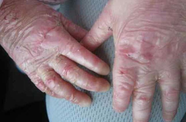 Bebés que nacen con ampollas pueden tener “Piel de Cristal” | Actualidad