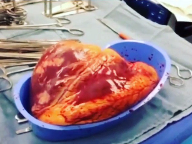 El corazón de un adicto a la cocaína latió durante 25 minutos fuera de su cuerpo | Curiosidades