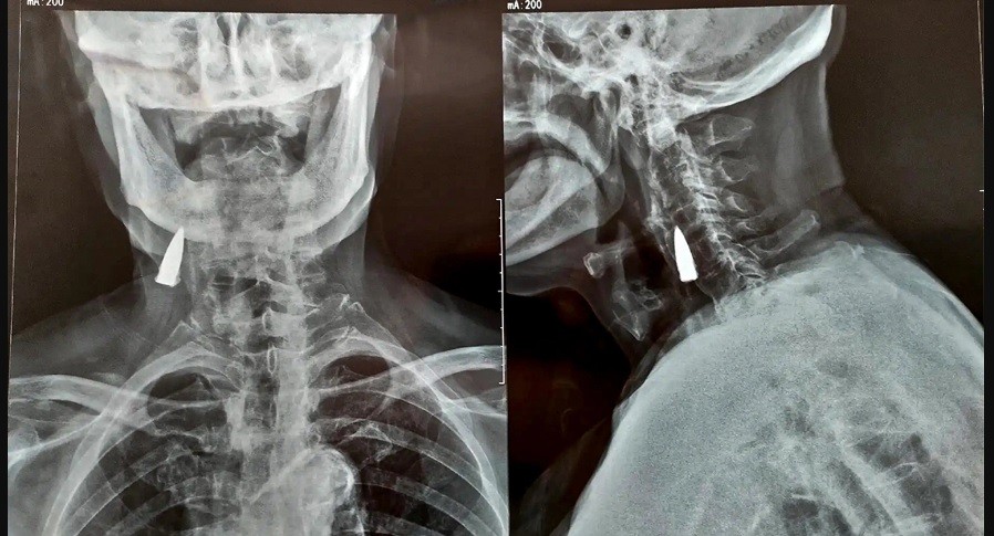 Tras sufrir una caída en su balcón, fue al hospital y descubrieron que tenía una bala en el cuello | Internacionales