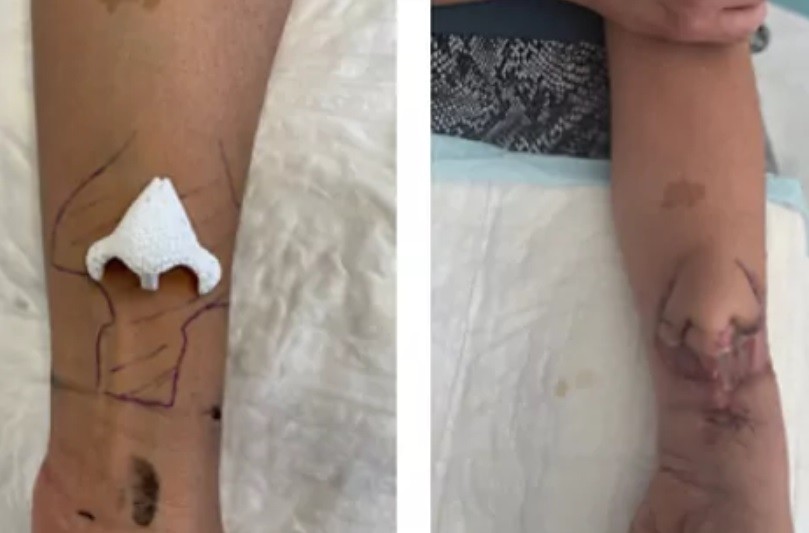 Injertaron la nariz en el brazo a una mujer para que recupere su olfato tras sufrir un cáncer | Internacionales