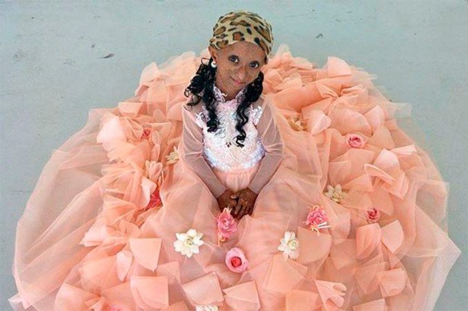 Tiene 18 años, pero una rara condición médica hace que su cuerpo tenga 144 | Curiosidades