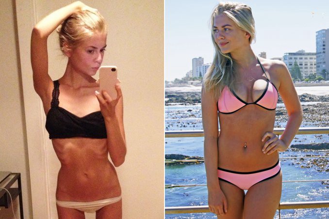 Una chica cuenta su pelea contra la anorexia a través de Instagram | Curiosidades