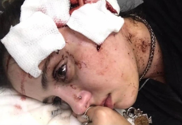 "Me arruinaron la cara": el drama de la camarera agredida por clientes en un bar de Mendoza | Actualidad