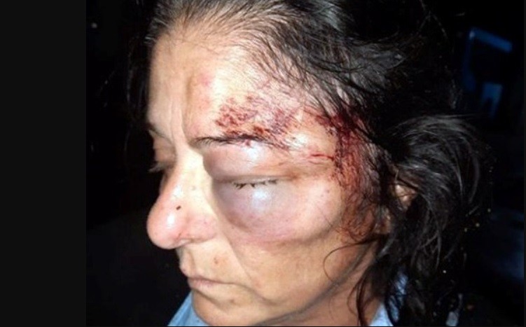Desfiguraron a una colectivera en un brutal asalto | Actualidad