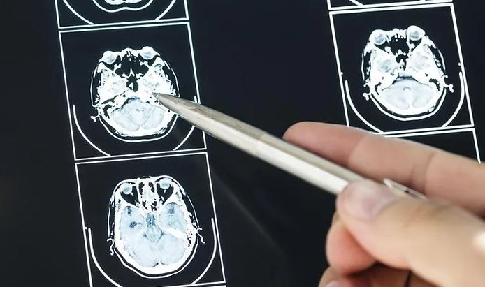 Cada día se detectan en Argentina 5 casos de tumores cerebrales: ¿cuáles son los signos de alerta? | Actualidad