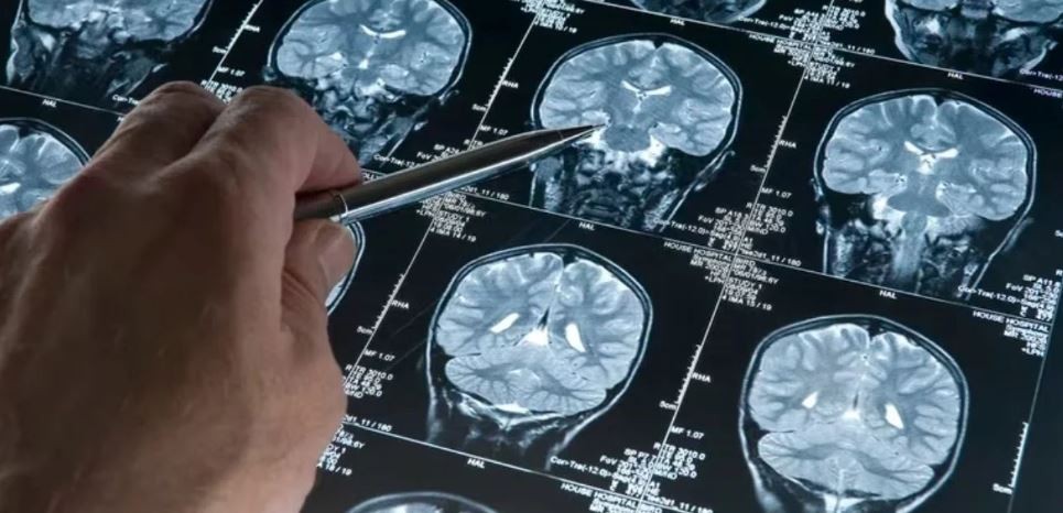 Científicos de la UBA investigan cómo detectar el Alzheimer con inteligencia artificial | Actualidad