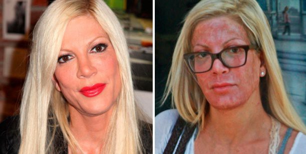 La protagonista de Beverly Hills 90210 que se desfiguró la cara | Espectáculos