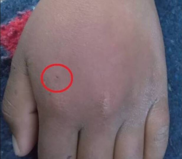 Para convertirse en Spiderman, un nene se hizo morder por una araña viuda negra: quedó internado | Internacionales