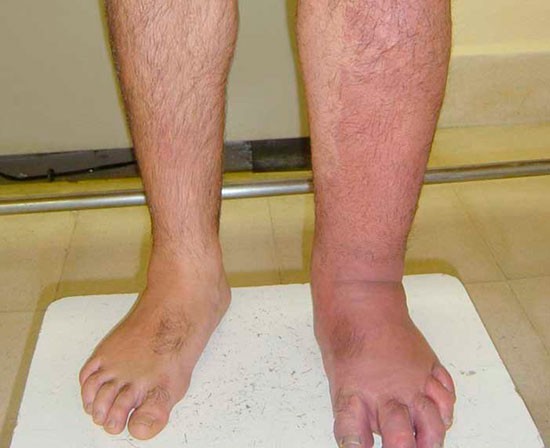 Linfedema: una enfermedad que afecta tanto al cuerpo como al estado anímico | Actualidad