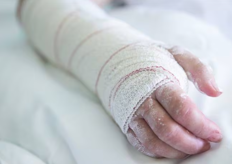 Por un reto viral de de TikTok, un adolescente terminó con el 30% de su cuerpo quemado | Actualidad