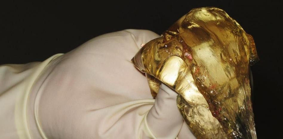 Ordenan indemnizar a 605 mujeres por implantes de prótesis mamarias defectuosas | Internacionales