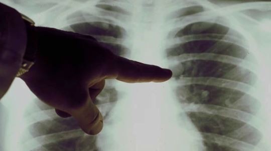 Presentan en la Argentina un nuevo tratamiento para un tipo de cáncer de pulmón | Actualidad