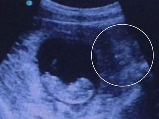 #EsViral Ecografía misteriosa: ¿un "demonio" vigila al feto? | Curiosidades