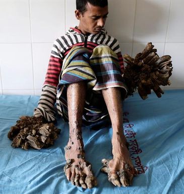 El "hombre árbol" será operado | Curiosidades