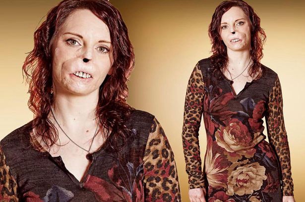 Mujer que perdió su nariz tras meningitis participará en un polémico show televisivo de citas | Espectáculos