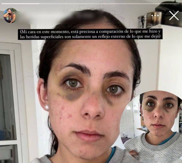 Un fisicoculturista golpeó brutalmente a su pareja en Córdoba | Actualidad