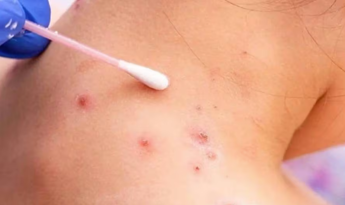 Se detectaron más de 20 casos de viruela del mono en Argentina | Actualidad