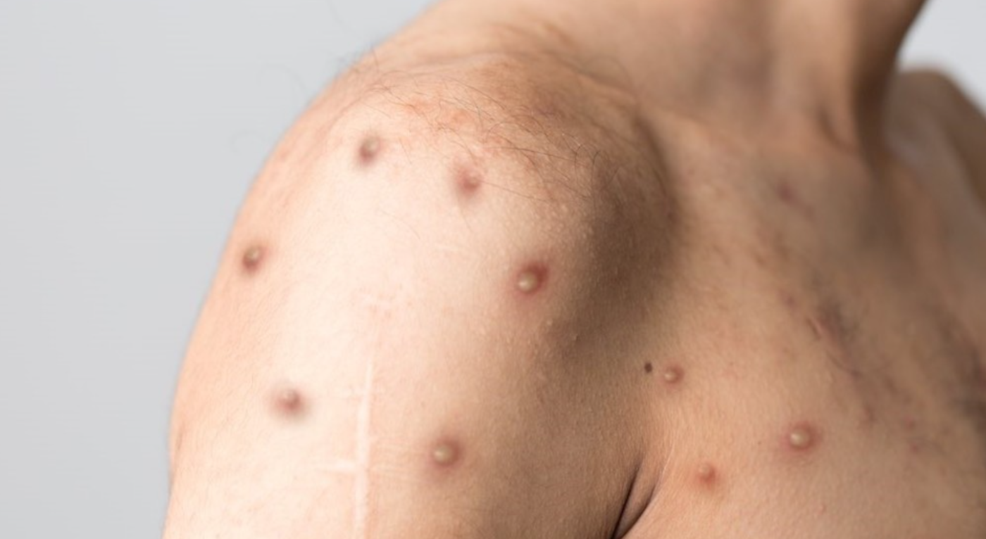 La Organización Mundial de la Salud aprobó la vacuna contra la viruela del mono | Actualidad