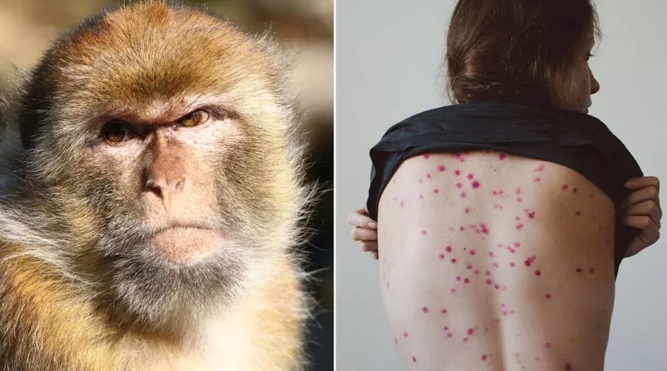 Se registraron siete casos nuevos de viruela del mono, todos en CABA | Actualidad