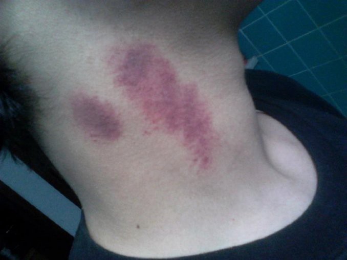 Un joven murió por el beso de su novia | Curiosidades