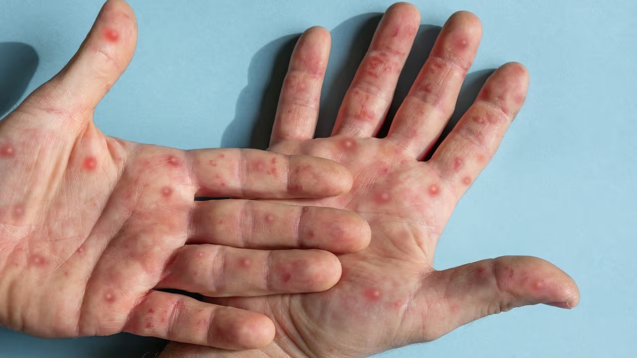 Detectaron dos nuevos casos de viruela símica en Córdoba | Actualidad