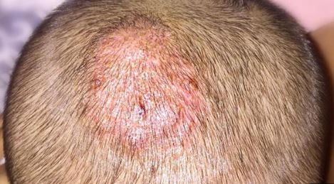 Se propaga una epidemia silenciosa de verano: cómo prevenir la tiña capilar | Actualidad