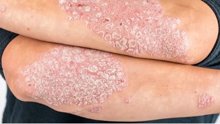 800 mil personas viven con psoriasis en Argentina | Actualidad