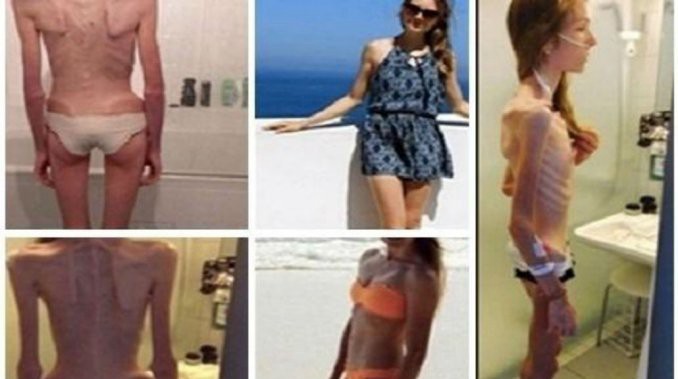 Sufría anorexia, llegó a pesar 31 kilos y ahora ayuda a otras chicas con el mismo problema | Curiosidades