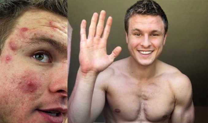 La historia del joven que venció al acné | Curiosidades