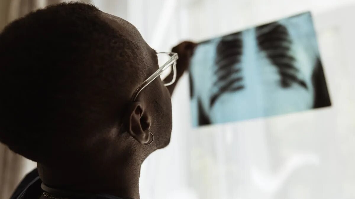 Los casos de tuberculosis aumentaron un 38% en Argentina | Actualidad