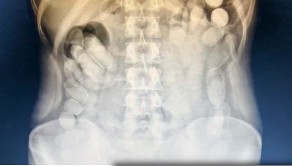 Tucumán: detienen a una pasajera que había ingerido más de 100 cápsulas de cocaína | Actualidad