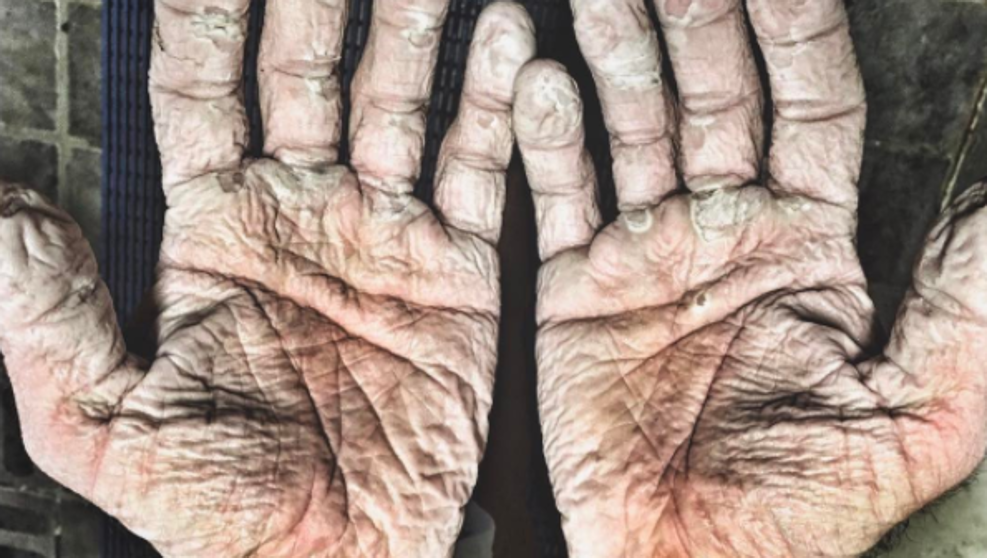 Así quedaron las manos del hombre que remó un mes en el Ártico | Deportes