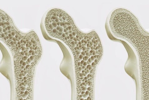 Día Mundial de la Osteoporosis: una de cada tres mujeres mayores de 50 años sufrirá una fractura por osteoporosis | Actualidad