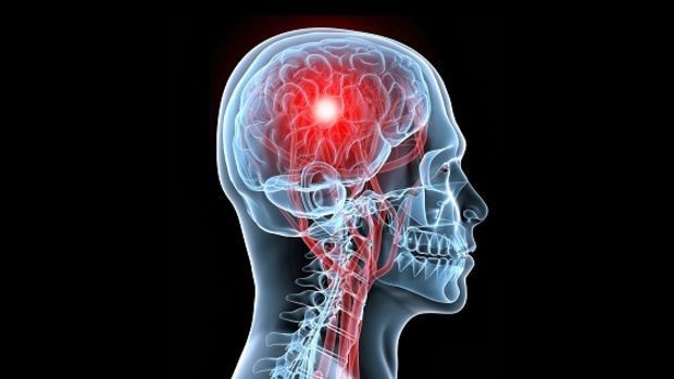 El eje psicológico del ACV: cuando la presión no es solo arterial | Actualidad