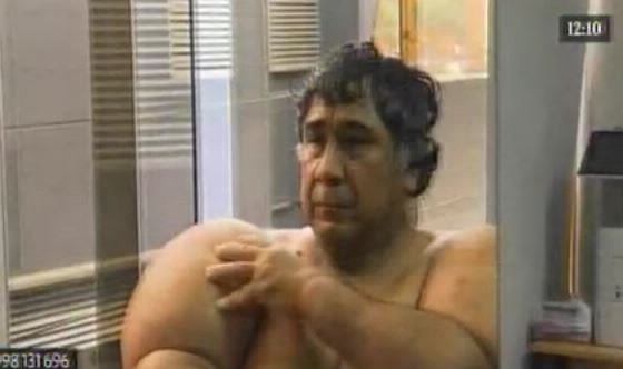 El calvario del hombre que vive con el cuerpo inflado por culpa del nitrógeno que aspiró | Curiosidades