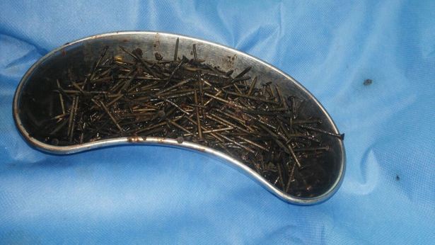 India: cirujanos extrajeron 600 clavos del estómago de un hombre con ayuda de un imán | Curiosidades