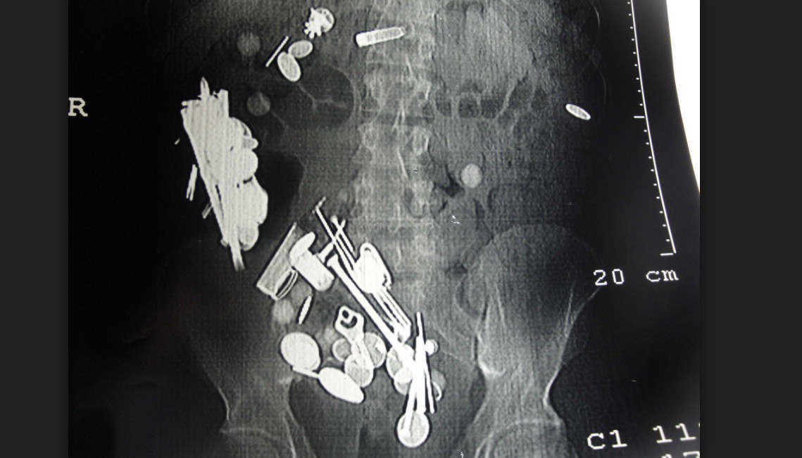 El extraño caso del hombre con depresión que se comió 263 monedas, 150 clavos y una correa para perros | Curiosidades