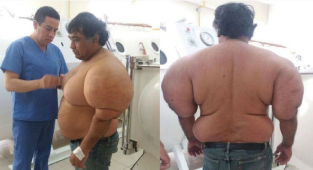 El extraño caso del buzo al que se le deformó el cuerpo después de un accidente con nitrógeno | Curiosidades