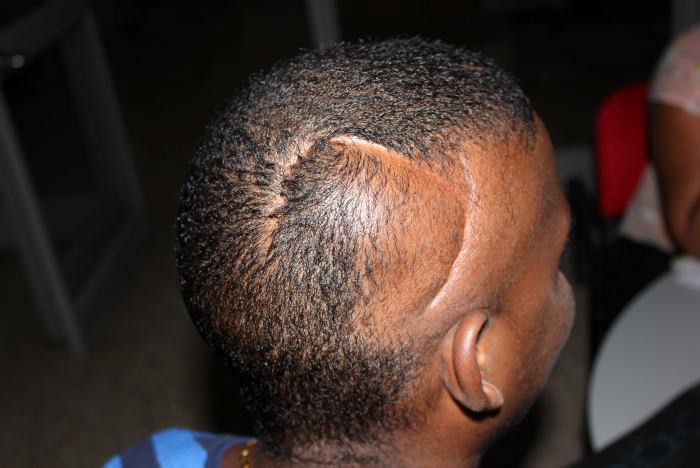 Le realizaron por error una cirugía cerebral a un paciente que no la necesitaba | Curiosidades