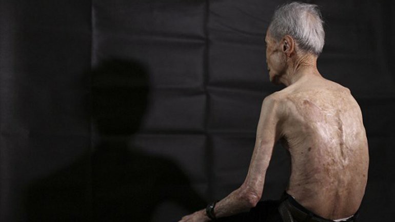 Las secuelas de la bomba atómica en el cuerpo de un sobreviviente | Internacionales