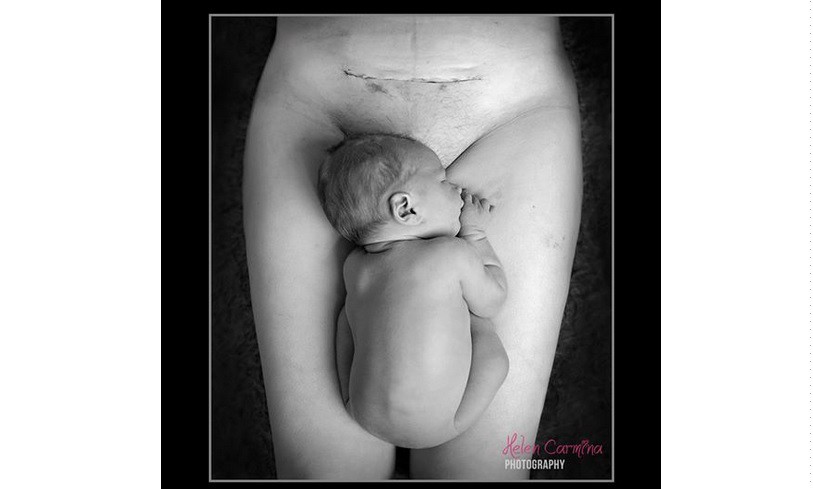 La foto de la cicatriz de una cesárea se vuelve viral | Internacionales