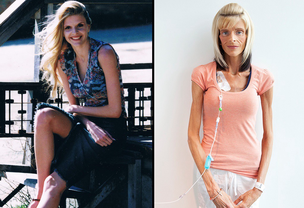 La triste historia de la ex modelo que no puede evitar adelgazar | Internacionales