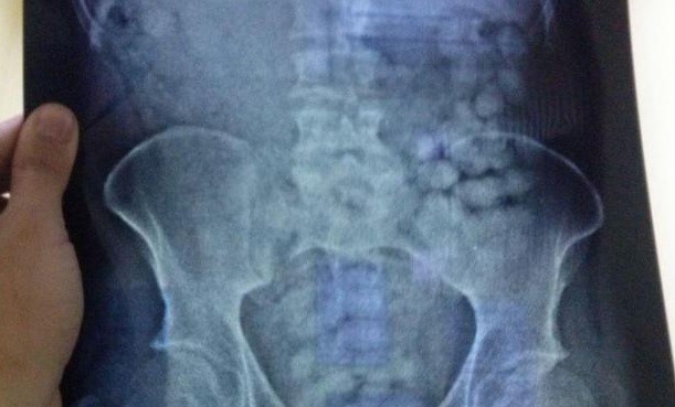 Uruguay: Detuvieron a un ciudadano holandés con más de un kilo de cocaína en el estómago | Internacionales