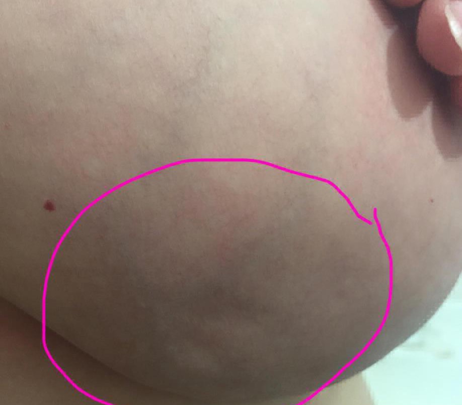 "Así se ve mi cáncer de mama" | Internacionales