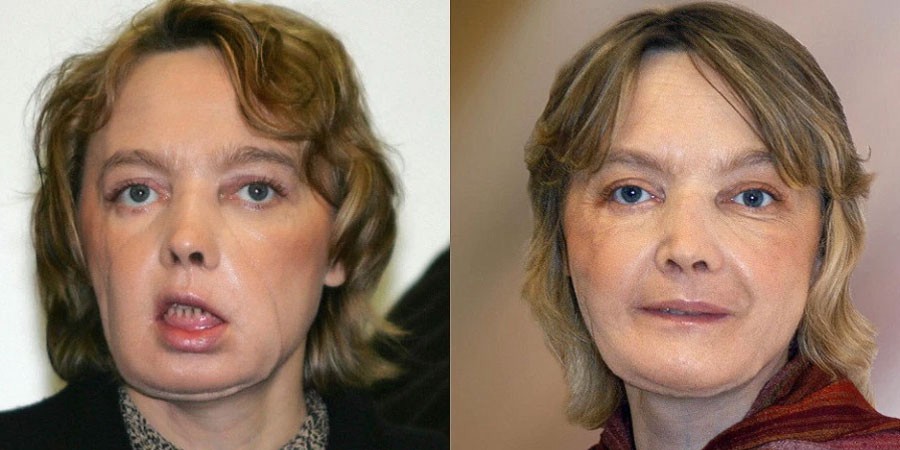 Murió la mujer francesa que recibió el primer trasplante de cara del mundo | Internacionales
