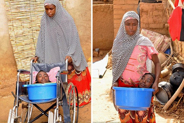 Murió la joven sin cuerpo que vivía en un balde | Internacionales