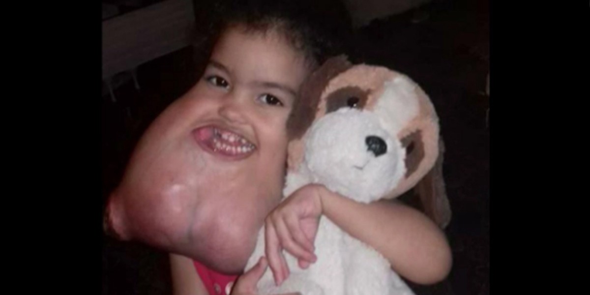 Cirujanos removieron un extraño tumor facial a una nena de tres años | Internacionales